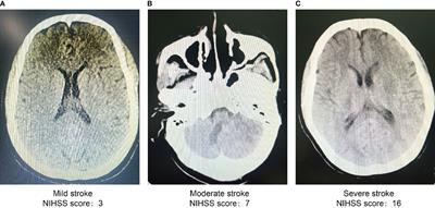 A cross-sectional analysis of the relationship between ischemic stroke and uric acid in young people in highland areas
